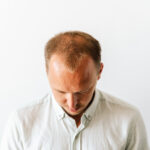 exosome tharapy for baldness patient